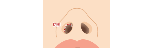 鼻プロテーゼの手術